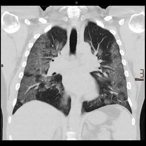 CT scan