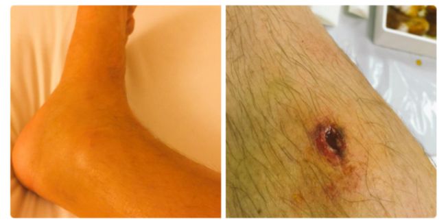 Las heridas con las que Biaggi afrontó la cita de Sepang